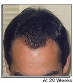 Hair Transplant Surgery