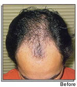 Hair Transplant Surgery