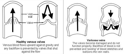 varicose veins