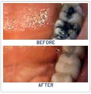 fillings